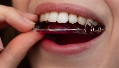 Dental Braces and Retainers: Types, Care, What to Expect